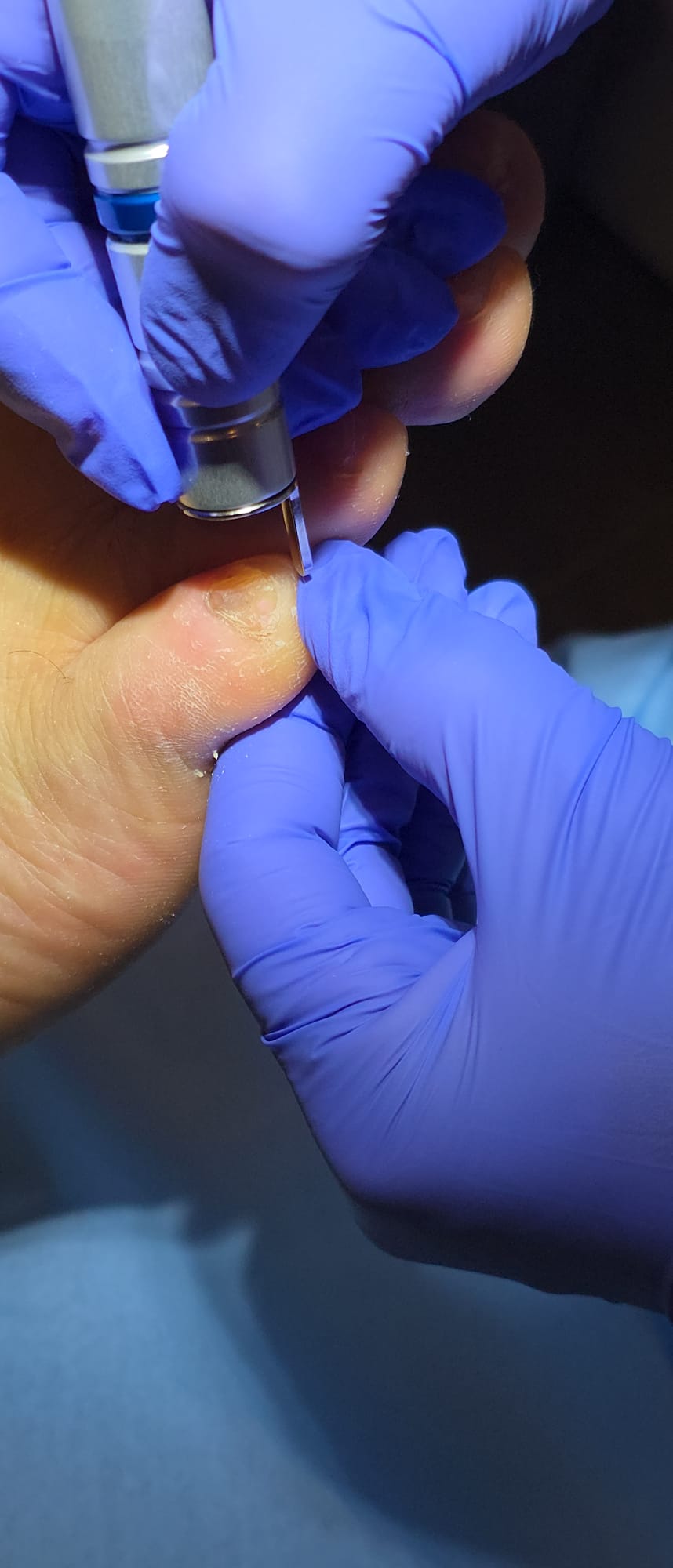 Pédicure médicale spécialisée